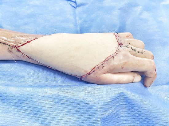Московские хирурги прооперировали «руку терминатора»